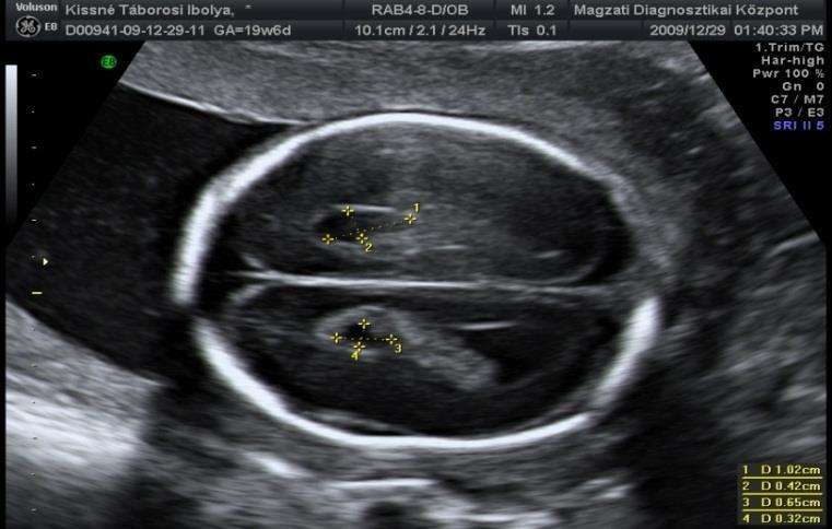 Ultrahangvizsgálatok a terhesség során - PDF Ingyenes letöltés