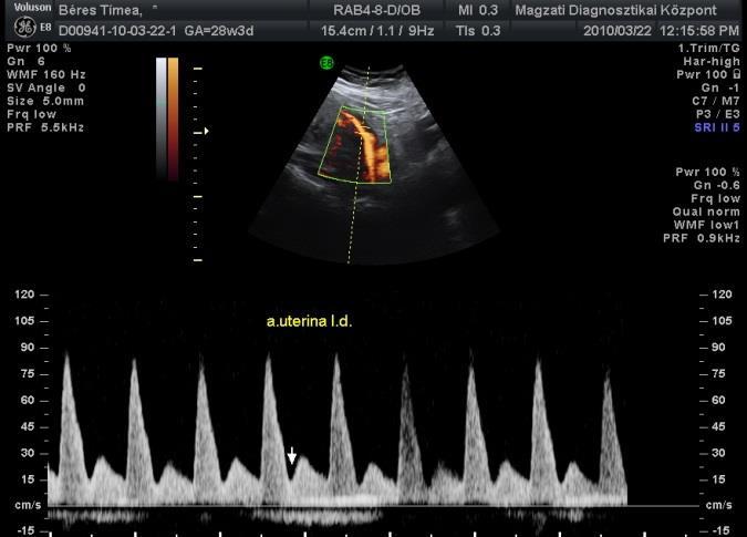 : diaphragma hernia, duodenum atresia, microcephalia, corpus callosum dysgenesis, pylon tágulat - korai
