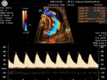 Arteria umbilicalis Doppler Hasi