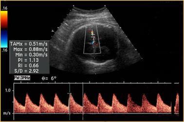 Kóros arteria cerebri media áramlás Hypoxaemiához való adaptatiót mutatja a csökkent ellenállás és a megnövekedett csúcssebességérték Cerebroplacentális hányados (CPR) MCA PI/UA PI A csúcssebesség a