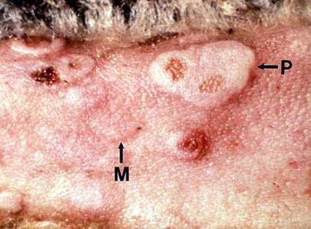Kórokozó: Swinepox(Suipoxvirus genus) fajspecifikus, nehezen izolálható bármely