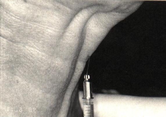 ARCRÁNC ÉS EGYÉB BŐRHIBÁK INJEKCIÓS KEZELÉSE CLOSTRIDIUM BOTULINUM EXOTOXIN (BOTOX-A) INJEKCIÓS KEZELÉS A beavatkozás után hasonló mellékhatásokra lehet számítani, mint a glabellaris injekciós