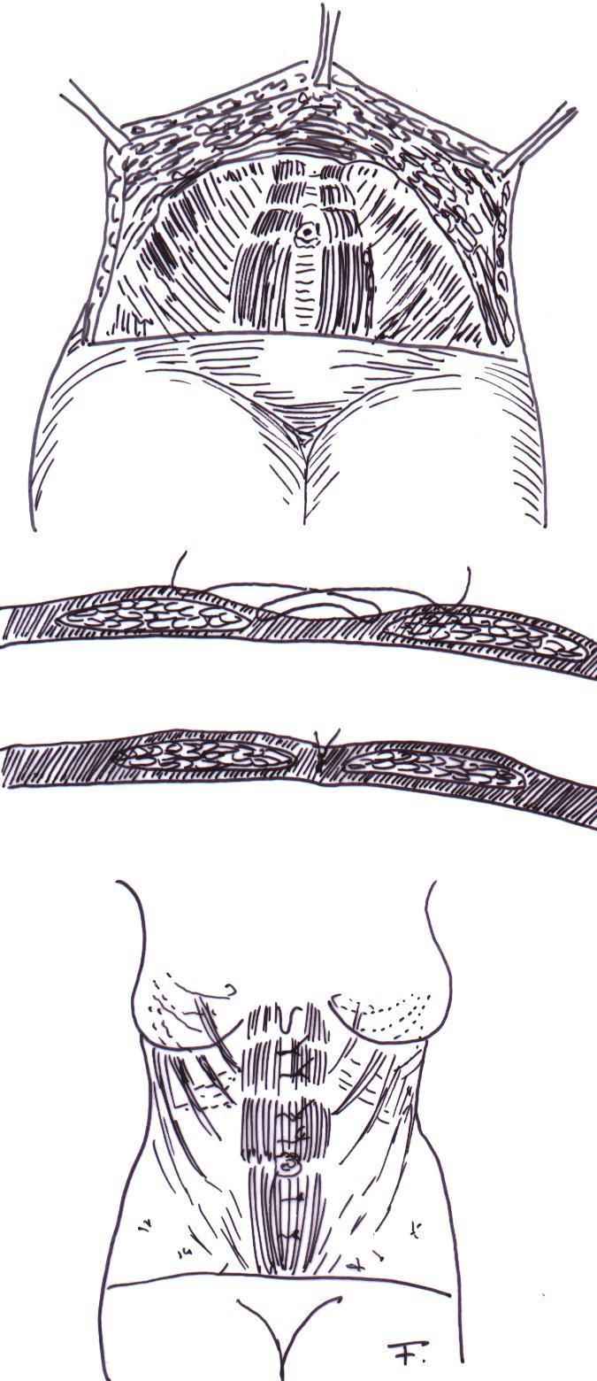 DERMOLIPECTOMIÁK ABDOMINOPLASZTIKA a linea albát is felvesszük. Az öltéssor a manubrium sternitől a symphysisig halad. 150. ábra. Abdominoplasztika folytatása Ezután a hasfal A. alápreparálás B.