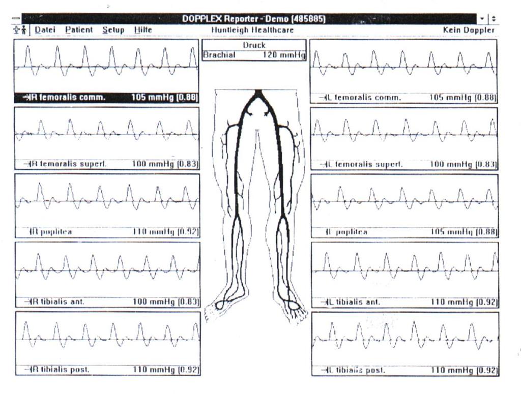 PROF. DR. VÁRADY ZOLTÁN * DR. IVANICS GYÖRGY 198. ábra. Doppler-görbék DUPLEX SZONOGRÁFIA Fekete-fehér vagy színes képet adó eljárás, ami szinte feleslegessé teszi az agresszív flebográfiát.