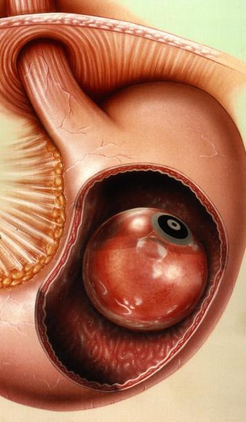 2 GYOMORÜREGBE HELYEZHETŐ BALLON BIOENTERICS INTRAGASTRIC BALLON SYSTEM (BIB SYSTEM) 213. ábra. Gyomor üregbe elhelyezhető ballon Étkezéskor a gyomor megtelésekor jóllakottságot érzünk.