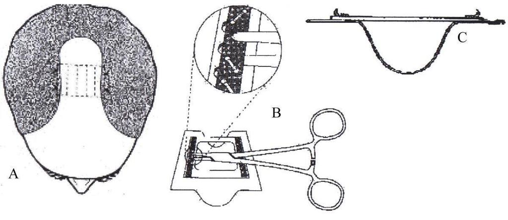 DR SIKOS GÉZA * DR IVANICS GYÖRGY 20. ábra. Extender szerkezete és elhelyezkedése A. extender behelyezve a fejen B. extender felülnézetből C. extender oldalnézetből B.