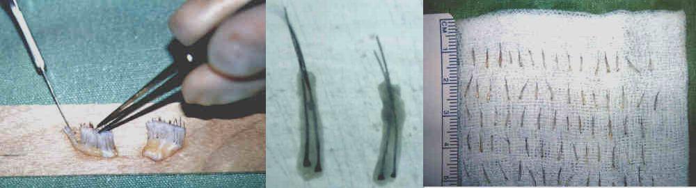 DR SIKOS GÉZA * DR IVANICS GYÖRGY 34. ábra. Graft készítés 1.7.