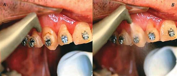 A ragasztófelesleg körül a dentális plakk még fogselyemmel sem tisztítható (B).