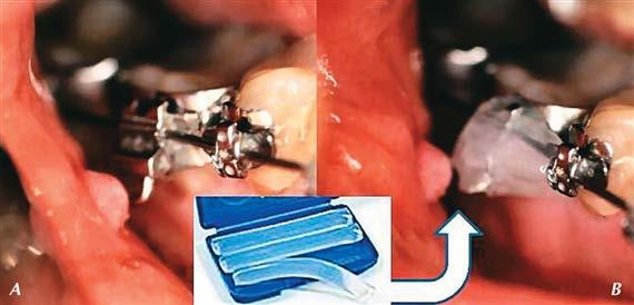 6.8. ábra A bakteriális korrózió következtében megbarnult látható ragasztófelesleg (A) eltávolítása polírozással (airflow) a bracketszél körül (B) Teháta ragasztott bracketek körül létrejövő