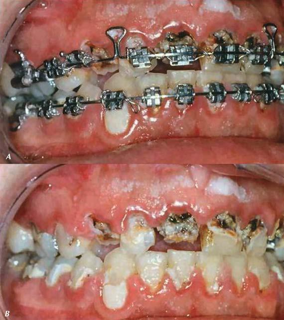 Preventív fogászat. Hatékony preventív fogászati módszerek integrálása az  orthodonciába. Dr. Végh András : - PDF Ingyenes letöltés