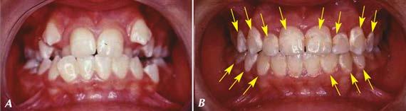 6.4. ábra Idiopáthiás gingivaszél sérülés következtében kialakuló, rapidan az apex irányába terjedő soliter gingivális recessió (Stillmann-hasadék) a túltágított, csont-fenesztrációval járó alsó