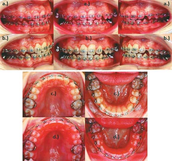 Preventív fogászat. Hatékony preventív fogászati módszerek integrálása az  orthodonciába. Dr. Végh András : - PDF Ingyenes letöltés