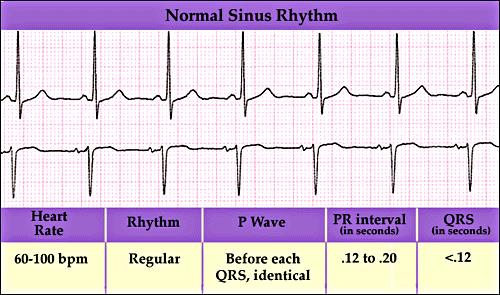 3. AZ EKG KOMPONENSEI Először meghatározzuk: Utána jellemezzük: 1. Szívfrekvencia 3. P hullám 2.