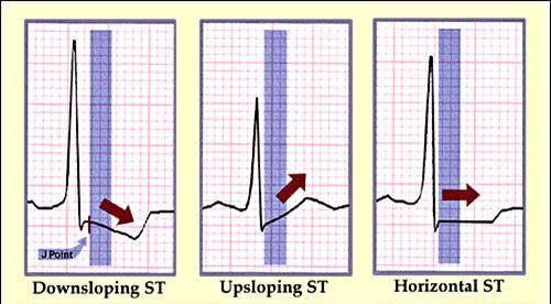 ST depresszió: a.) Junctionalis (aszcendáló) - általában normális (különösen tachycardia esetén). b.