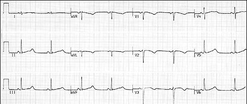 A rövid QT okai: 1. Digitalis hatás 2. Hypercalcaemia 3. Congenitalis short QT sy.