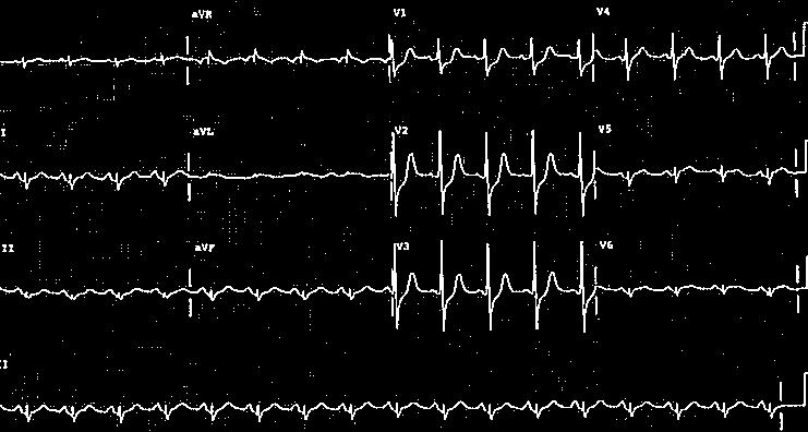 Inferior II, III, avf Posterior (nincs direkt