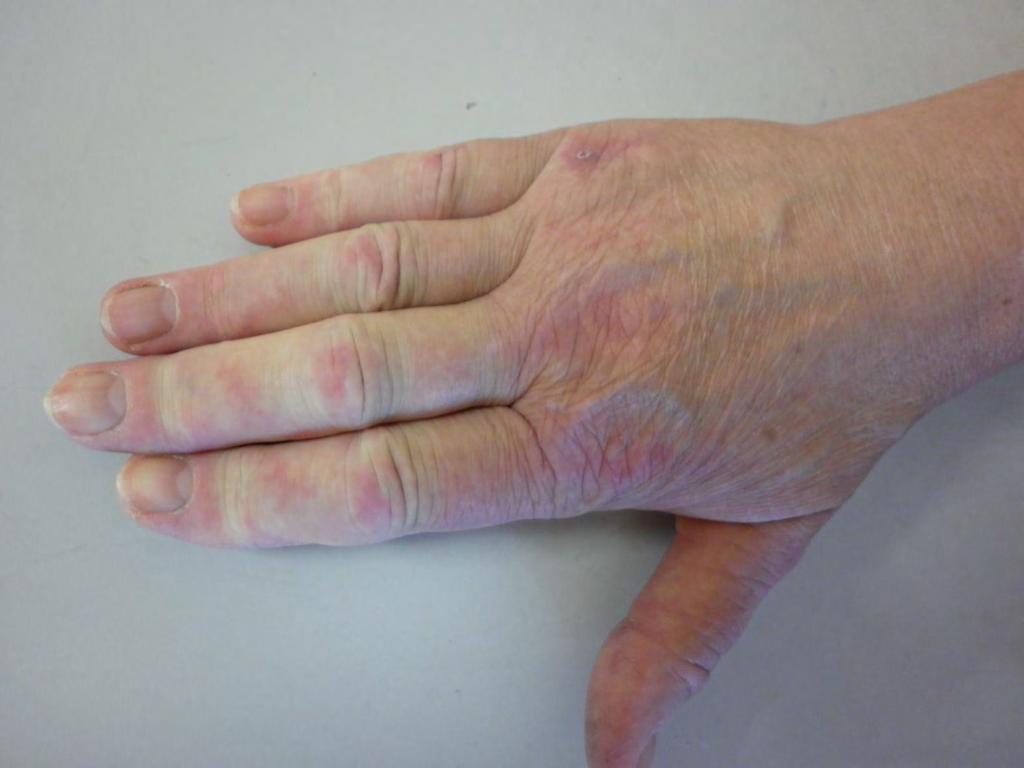 Ujjvasculitis