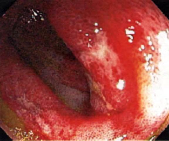 Gastrointestinalis vasculitis Henoch-Schönlein
