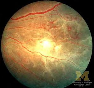 Szemfenéki (retinalis) vasculitis Behüvelyezett erek (vasculitises