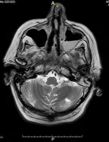Sinus sphenoidalis l.d.: gyulladás jelei láthatók + levegőzárványok A rostasejtek részben kitöltöttek.