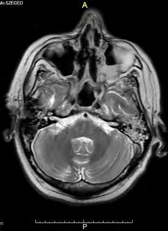 ráterjed. Sinus maxillaris l.d.: keskeny körkörös nyálkahártya megvastagodás látszik, l.s. folyadéknívó észlelhető.