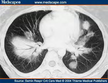 GPA granuloma