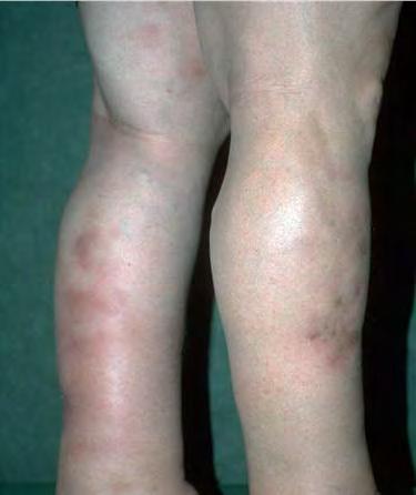 Erythema