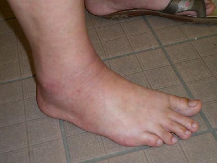 vasculitis