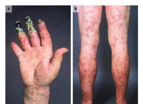 Polyarteritis nodosa