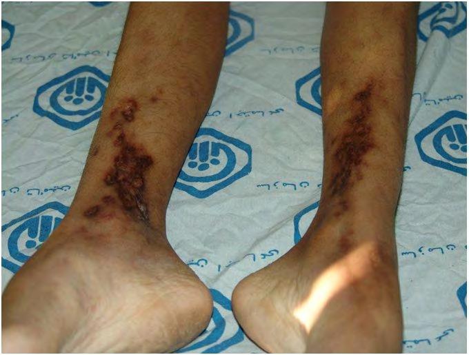 Polyarteritis nodosa