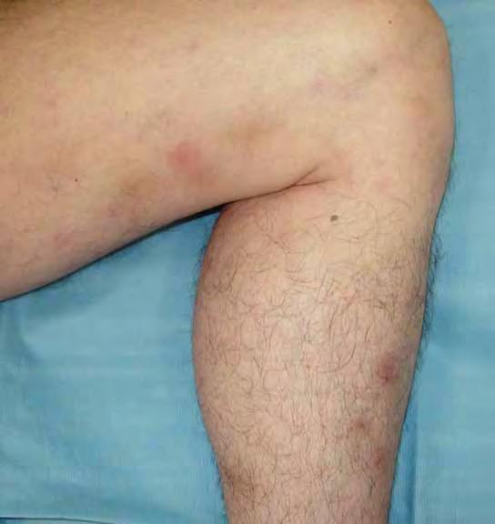 Polyarteritis nodosa