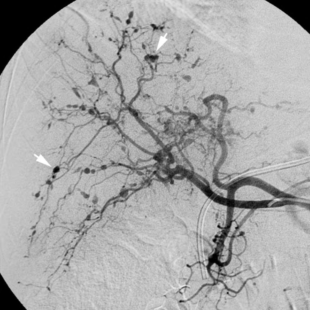 Figure 3b: Frontal (a) renal and (b) hepatic arteriograms Rhodes, E. S. et al.