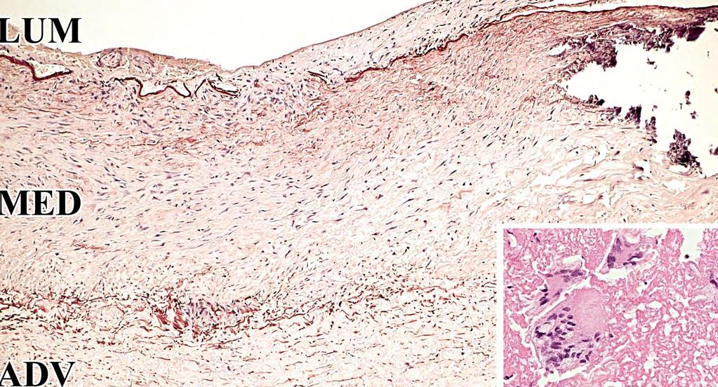 Óriássejtes arteritis szövettan