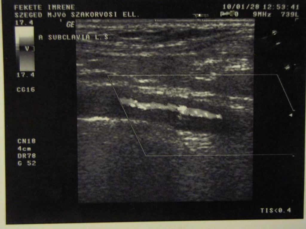 Halo -jel (Gyűrű-jel) Takayasu arteritis,