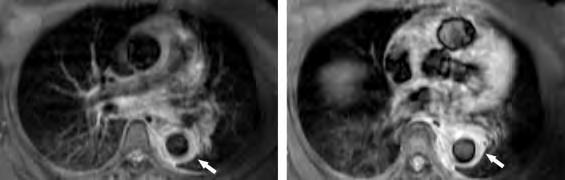 Zsírelnyomásos T2 MRI képek a mellkasi aortáról gyulladásra oedemára utaló hyperintenzív jelek a mellkasi aorta falában MTX vagy AZA