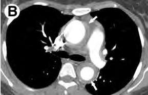 Aortitis és aorta