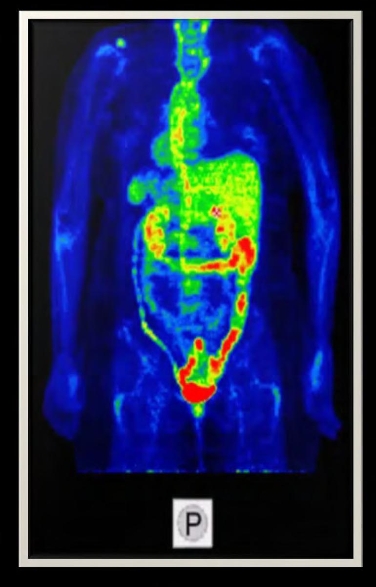 F-FDG-PET/CT Aktív nagyérvasculitis terápia utáni kontrol