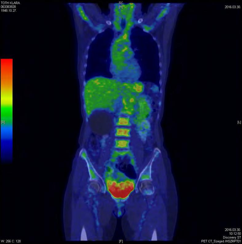 18-FDG-PET-CT Előnyei: Egész test Tumor, fertőzéses góc egyidejű kizárása PMR-ben a társuló GCA kizárása