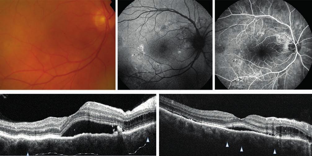 Importance of choroidal thickness in eye diseases lo pa thia (PCV/aneurysmalis 1. típusú okkult CNV; AT1). Peripapillaris pachychorioidealis szindróma (PPS).