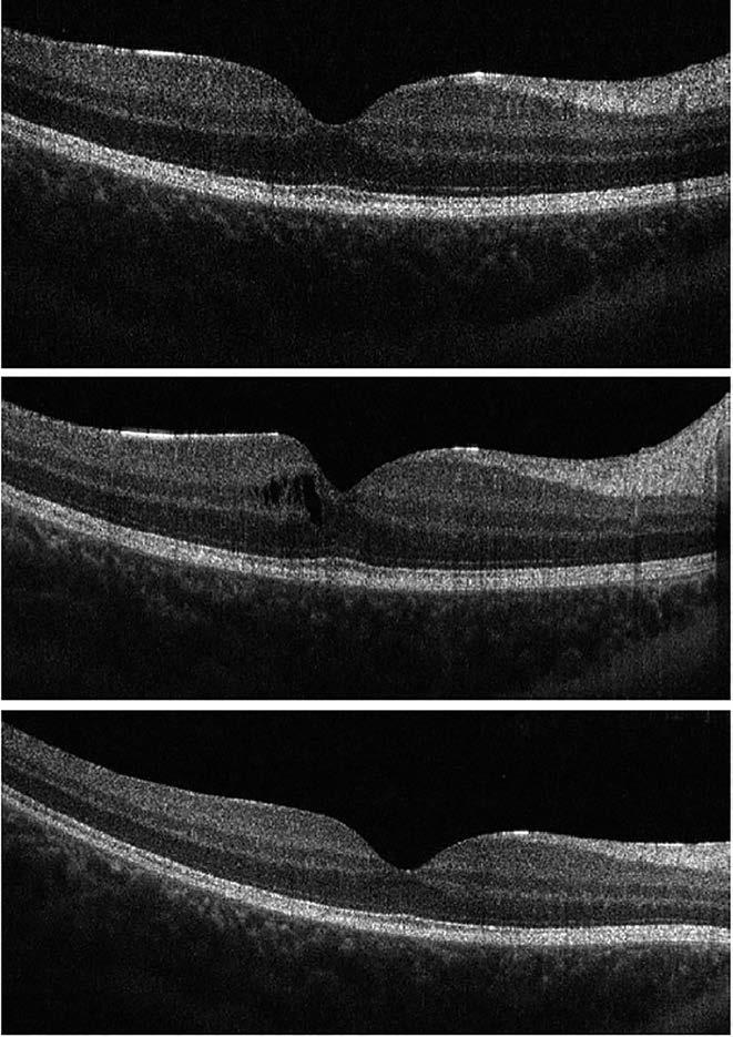 A chorioidea-vastagság jelentősége szemfenéki kórképekben ülső uveitisben a chorioidea-vastagság és az uveitis aktivitása erős öszszefüggést mutatott (61).