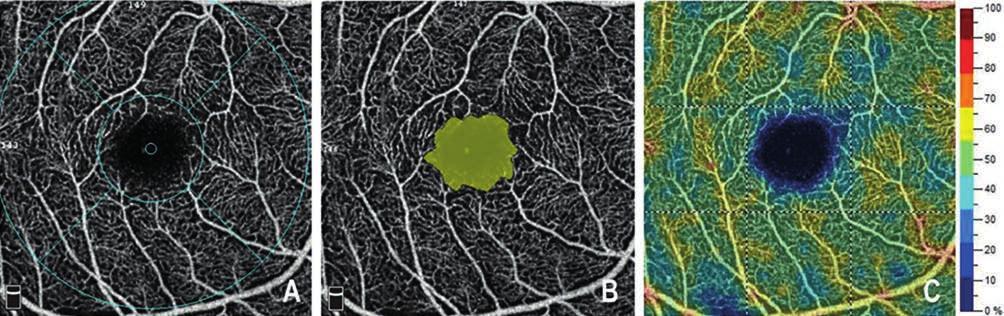Evaluation of retinal perfusion using OCT angiography in healthy children Bevezetés Az optikai koherencia tomográfia angiográfia (OCTA) hazánkban és a világon egyaránt néhány éve elérhető szemészeti