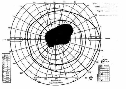 Az LHON-t kezdetben gyakran tévesen opticus neuritisként diagnosztizálják, ami késleltetett diagnózisokhoz vezethet (3). Az LHON diagnózisát genetikai vizsgálattal kell igazolni (17).