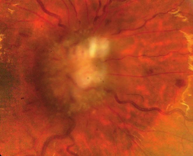 Fundus changes in acute lymphoblastic leukemia pancytopenia, tumorsejtes infiltráció, a kezelés okozta immunszupp - resszió, és kemoterápiás szerek toxicitása miatt.