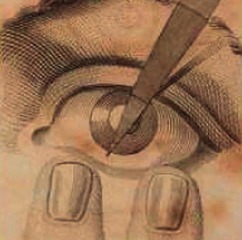 A glaukóma nem járt cornea - borússággal, nem valószínűsíthető, hogy zárt zuggal járó roham lehetett volna. A család a műtétet a hosszú ideje fennálló erős fájdalmak miatt erőszakolta ki.