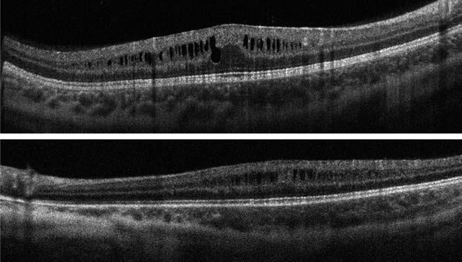 Importance of choroidal thickness in eye diseases a Chorioidea-vastagság változása kóros körülmények között nagyfokú rövidlátás Az alábbiakban idézett közleményekben a rövidlátás fogalma a fokozott