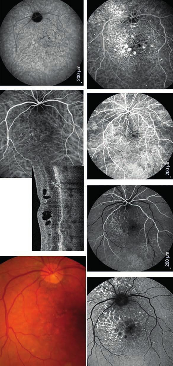 Importance of choroidal thickness in eye diseases 5. A ábra: Polypoidealis chorioidealis vasculopathia.