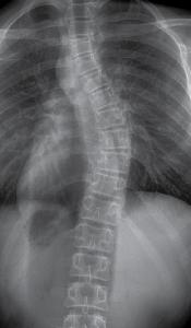 A Magyar Edzők Társaságának folyóirata 2019/04 1. ábra Scoliosis röntgen képe 2. ábra Idiopathiás scoliosis 3.
