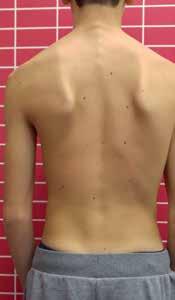 A konzervatív kezelés két fő eleme a Katharina Schroth szerinti Háromdimenziós Scoliosis Terápia (4. ábra) és a növekedést szabályozó segédeszköz, a korzett alkalmazása.