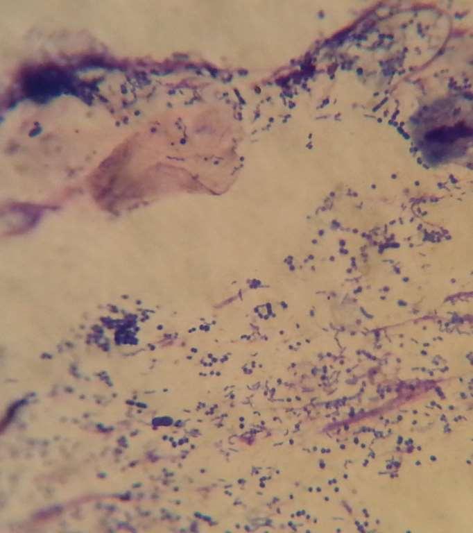 Citológia Nagy mennyiségű kokkoid/pálca (Pseudomonas spp) alakú