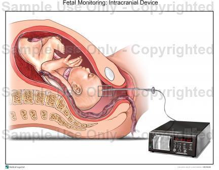 Szülés alatti intenzív észlelés Cardiotocographia